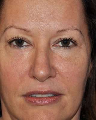 Blepharoplasty Before & After Patient #8067