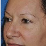 Blepharoplasty Before & After Patient #8067