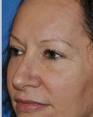 Blepharoplasty Before & After Patient #8067