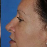Blepharoplasty Before & After Patient #8067