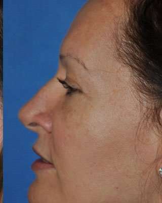 Blepharoplasty Before & After Patient #8067