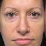 Blepharoplasty Before & After Patient #8067