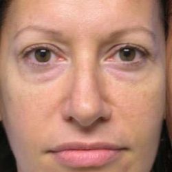 Blepharoplasty Before & After Patient #8067