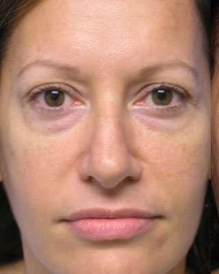 Blepharoplasty Before & After Patient #8067