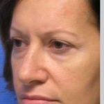 Blepharoplasty Before & After Patient #8067