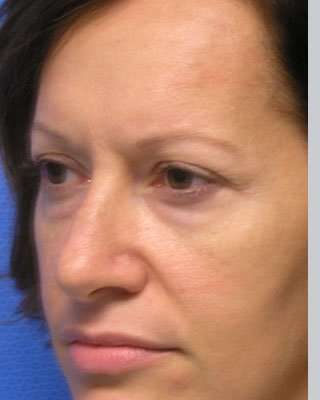 Blepharoplasty Before & After Patient #8067