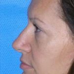 Blepharoplasty Before & After Patient #8067