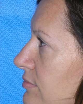 Blepharoplasty Before & After Patient #8067