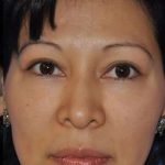 Blepharoplasty Before & After Patient #8060