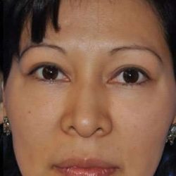 Blepharoplasty Before & After Patient #8060
