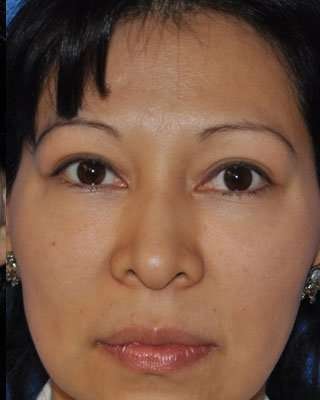 Blepharoplasty Before & After Patient #8060