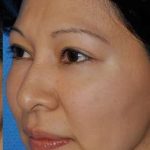 Blepharoplasty Before & After Patient #8060