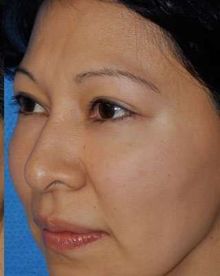 Blepharoplasty Before & After Patient #8060