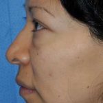 Blepharoplasty Before & After Patient #8060