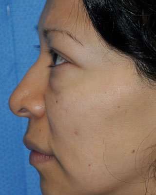 Blepharoplasty Before & After Patient #8060