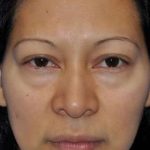 Blepharoplasty Before & After Patient #8060