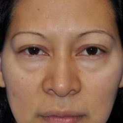 Blepharoplasty Before & After Patient #8060