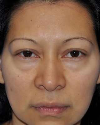 Blepharoplasty Before & After Patient #8060