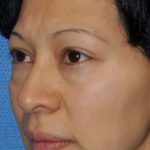 Blepharoplasty Before & After Patient #8060