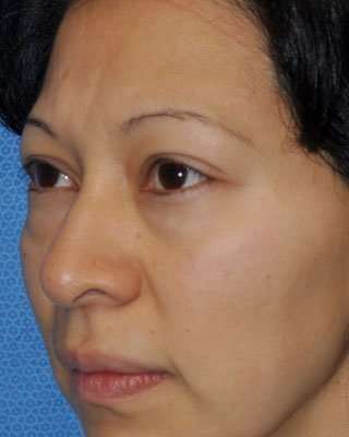 Blepharoplasty Before & After Patient #8060