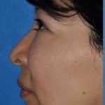 Blepharoplasty Before & After Patient #8060