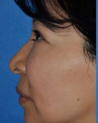 Blepharoplasty Before & After Patient #8060