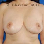 Breast Lift Before & After Patient #8855