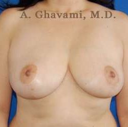 Breast Lift Before & After Patient #8855