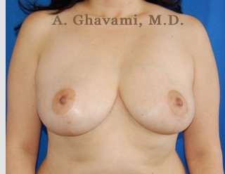 Breast Lift Before & After Patient #8855