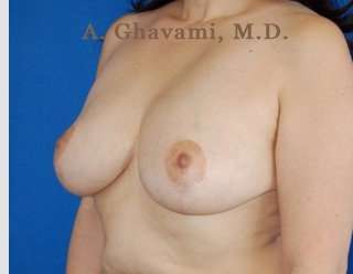 Breast Lift Before & After Patient #8855