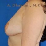 Breast Lift Before & After Patient #8855