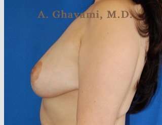 Breast Lift Before & After Patient #8855