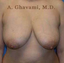 Breast Lift Before & After Patient #8855