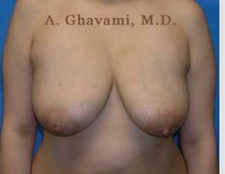 Breast Lift Before & After Patient #8855