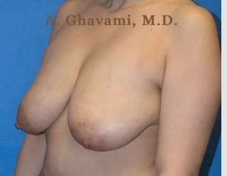 Breast Lift Before & After Patient #8855