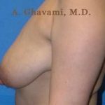 Breast Lift Before & After Patient #8855