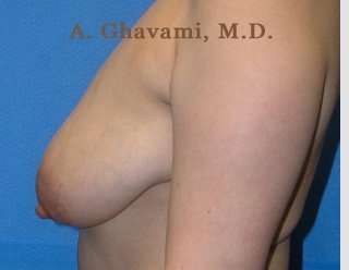 Breast Lift Before & After Patient #8855