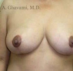 Breast Lift Before & After Patient #8848