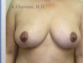 Breast Lift Before & After Patient #8848