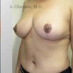 Breast Lift Before & After Patient #8848