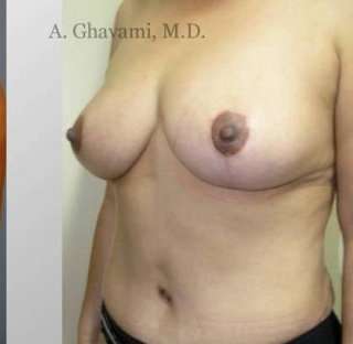 Breast Lift Before & After Patient #8848