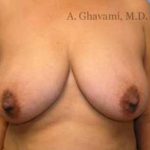 Breast Lift Before & After Patient #8848