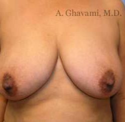 Breast Lift Before & After Patient #8848