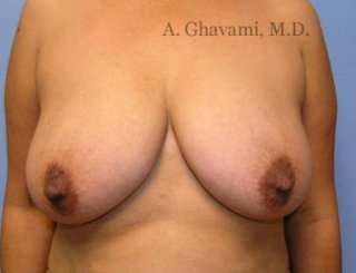 Breast Lift Before & After Patient #8848