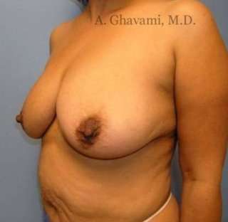 Breast Lift Before & After Patient #8848