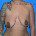 Breast Lift Before & After Patient #8843