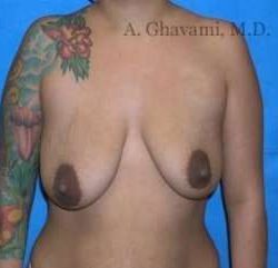 Breast Lift Before & After Patient #8843