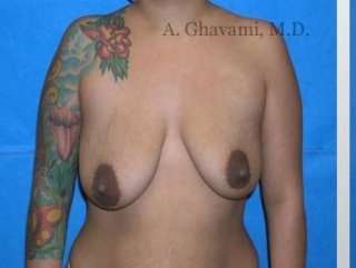 Breast Lift Before & After Patient #8843