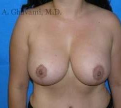 Breast Lift Before & After Patient #8840