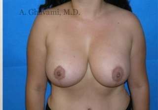 Breast Lift Before & After Patient #8840